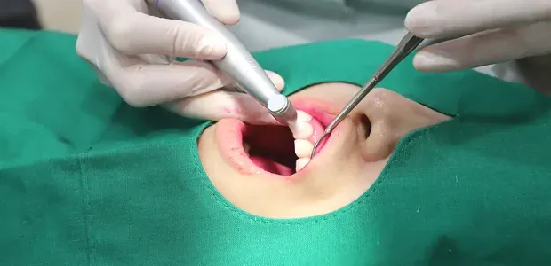歯面研磨