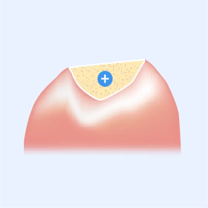 足りない部分に骨補填材を詰めるイラスト