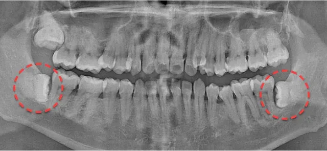 抜歯前のパノラマX線写真。左右下の埋伏親知らずを赤い点線で表示