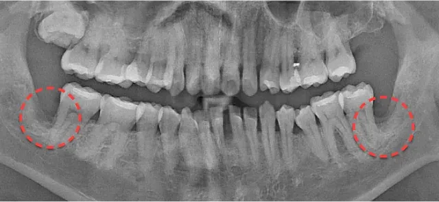 抜歯後のパノラマX線写真。左右の親知らずを抜いた部位を赤い点線で表示