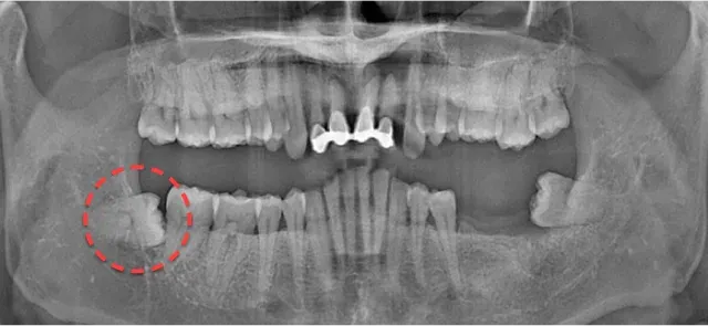 抜歯前のパノラマX線写真。右下の埋伏親知らずを赤い点線で表示