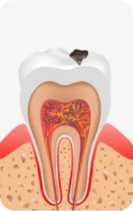 エナメル質の内側の象牙質まで広がった虫歯のイラスト