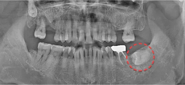 抜歯前のパノラマX線写真。左下の埋伏親知らずを赤い点線で表示