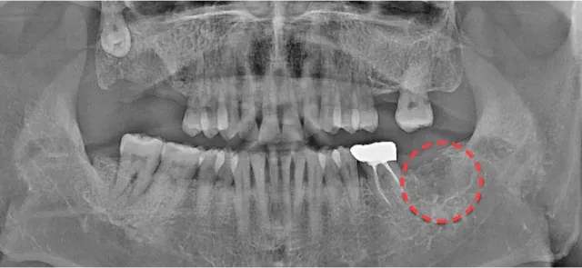 抜歯後のパノラマX線写真。親知らずを抜いた部位を赤い点線で表示