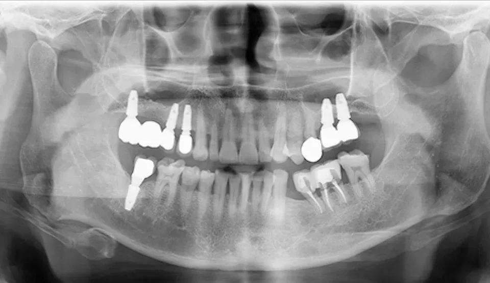 実際の両親のインプラント手術1年後のパノラマX線写真
