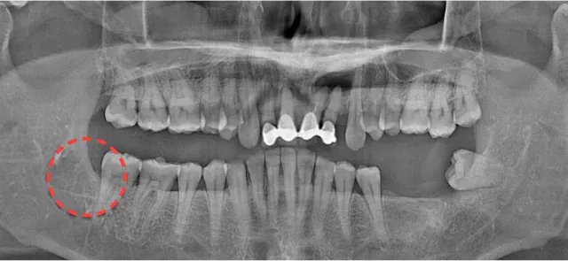 抜歯後のパノラマX線写真。親知らずを抜いた部位を赤い点線で表示