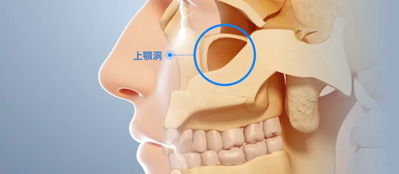 上あごの骨の中の空洞である上顎洞の位置を示した横顔のイラスト