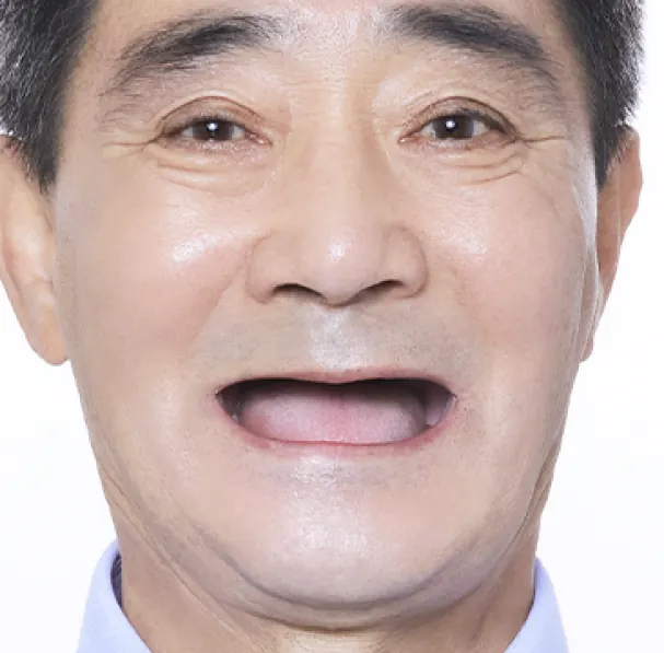 オク**様（60代） 治療前