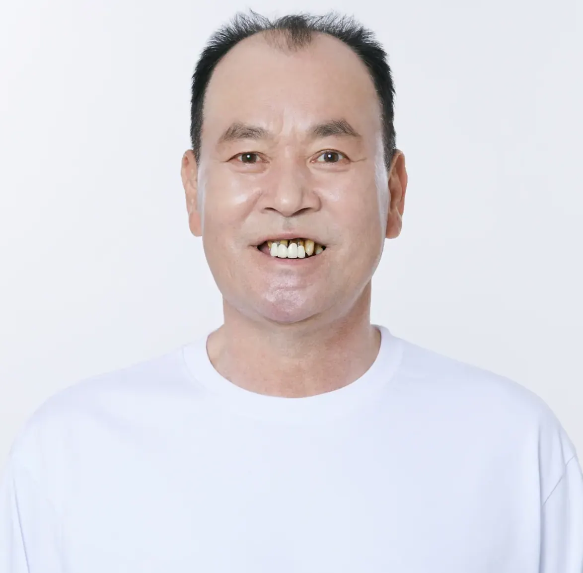 キム**様(60代) インプラント(ソウル院) 治療前